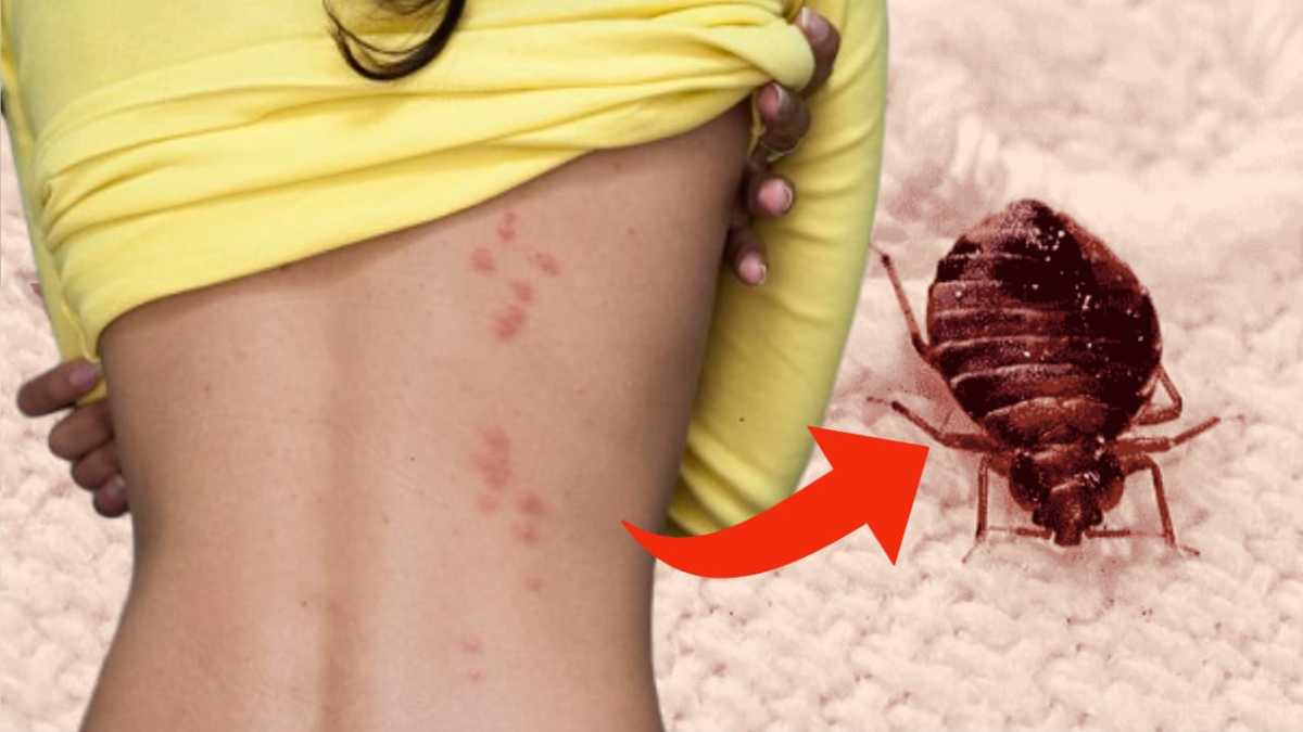 Check the mattress. If you have these spots on your skin, your bed is infested with bedbugs